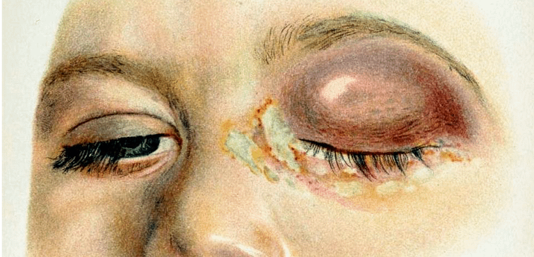 Ultrason POCUS oeil