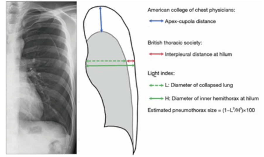 Mesure du pneumothorax